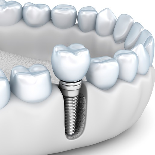 Illustration showing traditional dental implant between natural teeth