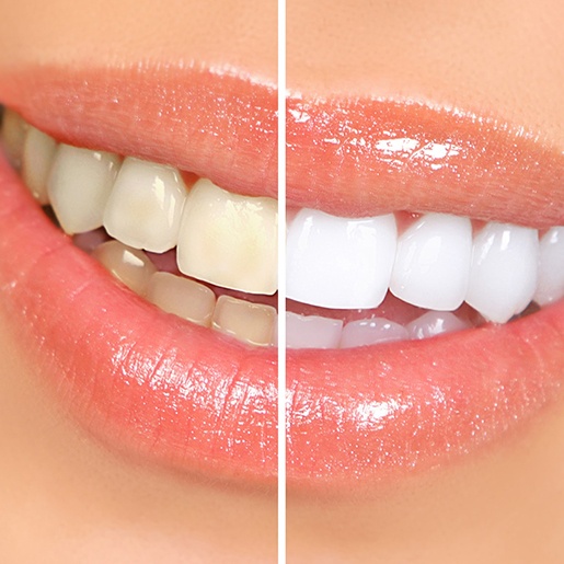 Before and after teeth whitening results